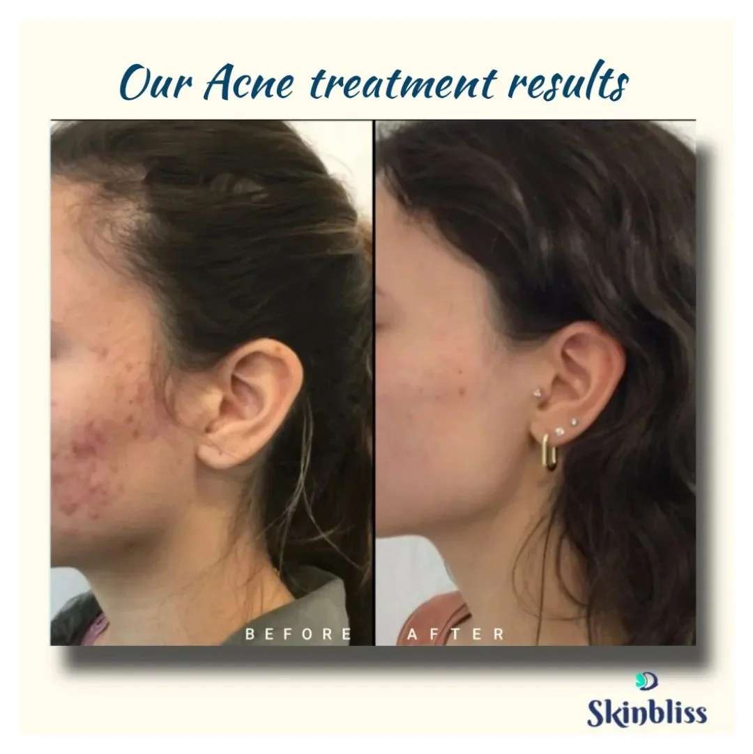 Acne-Scars-Treatment