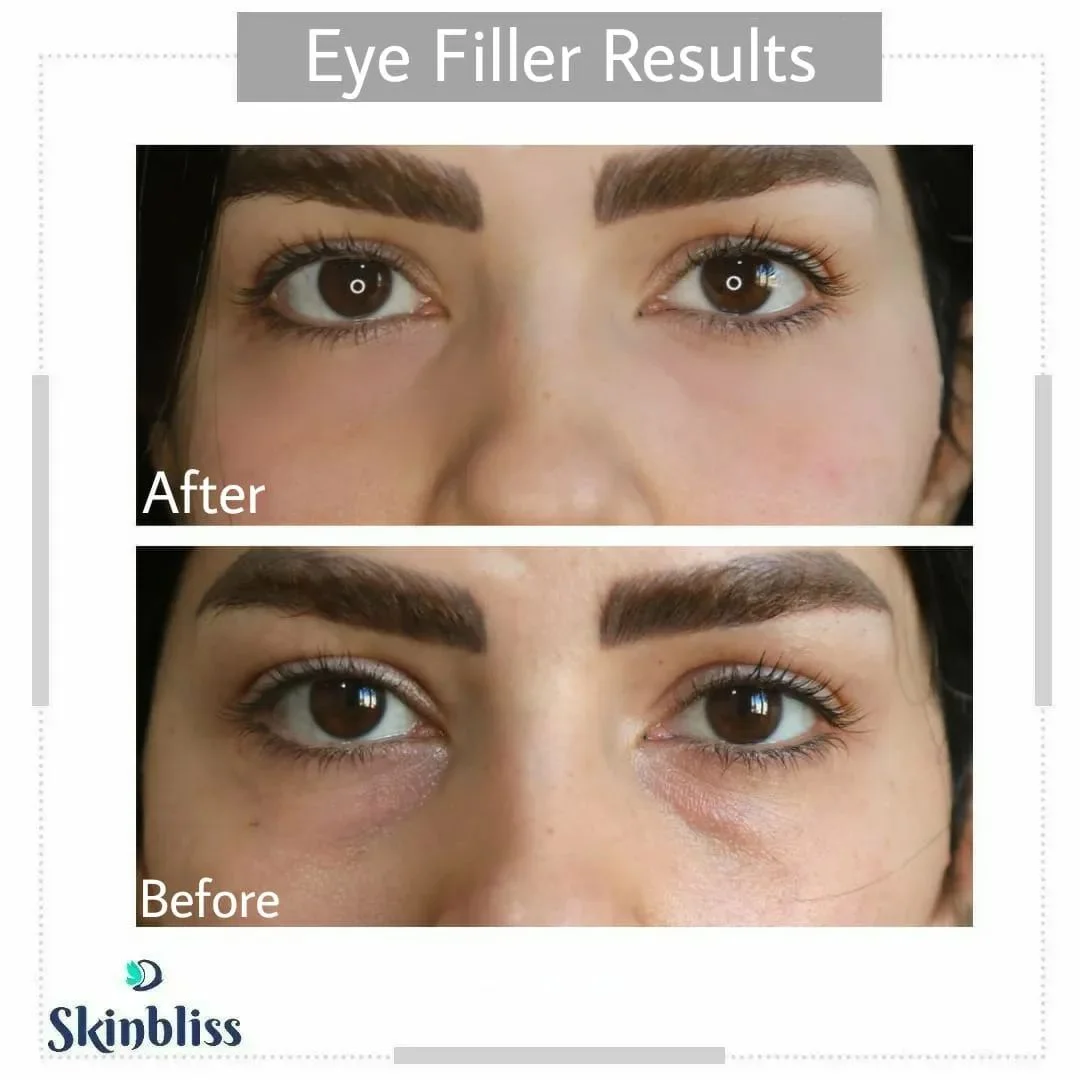 Eye-Fillers-Treatment (1)