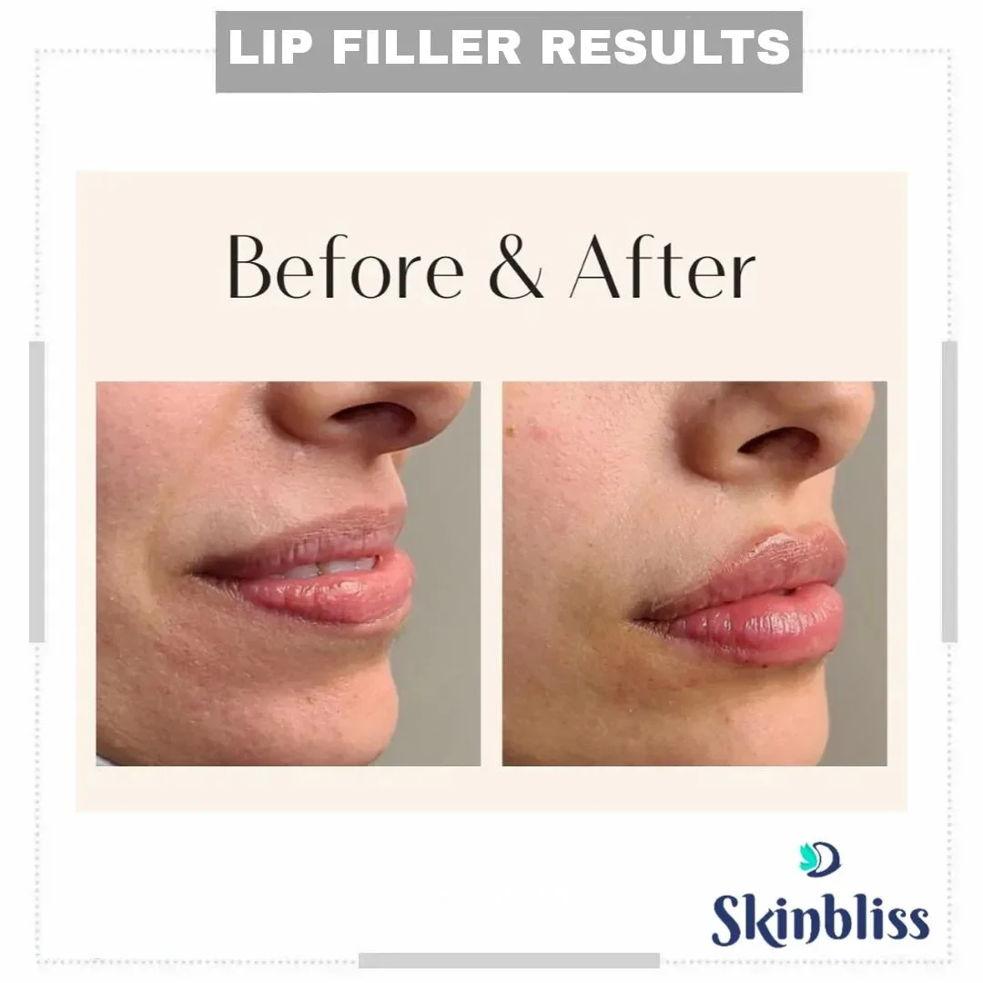 Lip-Fillers-Treatment