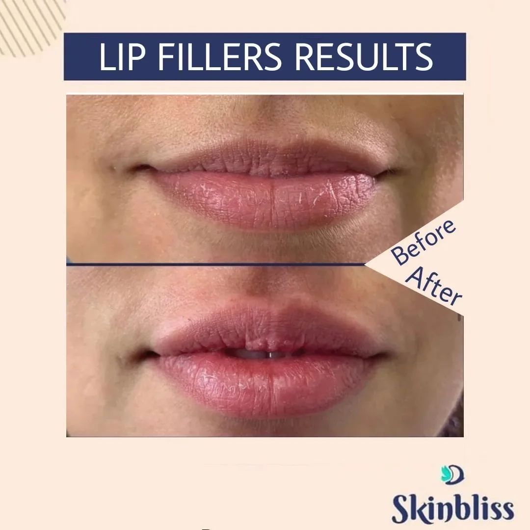 Lips-Filler-Treatment