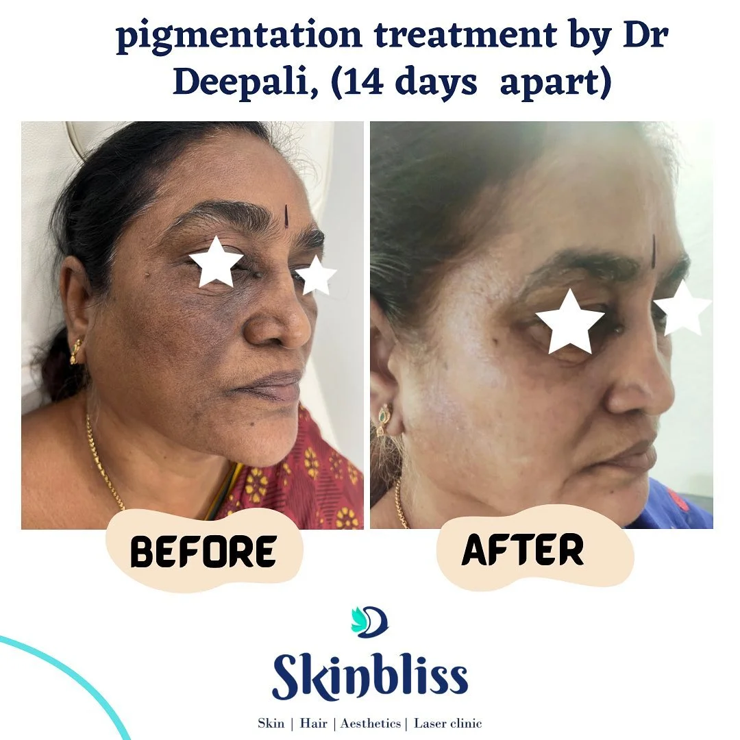 Pigmentation-Treatment