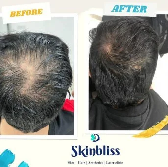Scalp-Micropigmentation-qou0us9mdy0pcv1jhrjgdnsaw1jh049bd3yi59fwv0